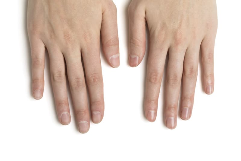 Dr. Dana Nail Renewal System Hands before and after