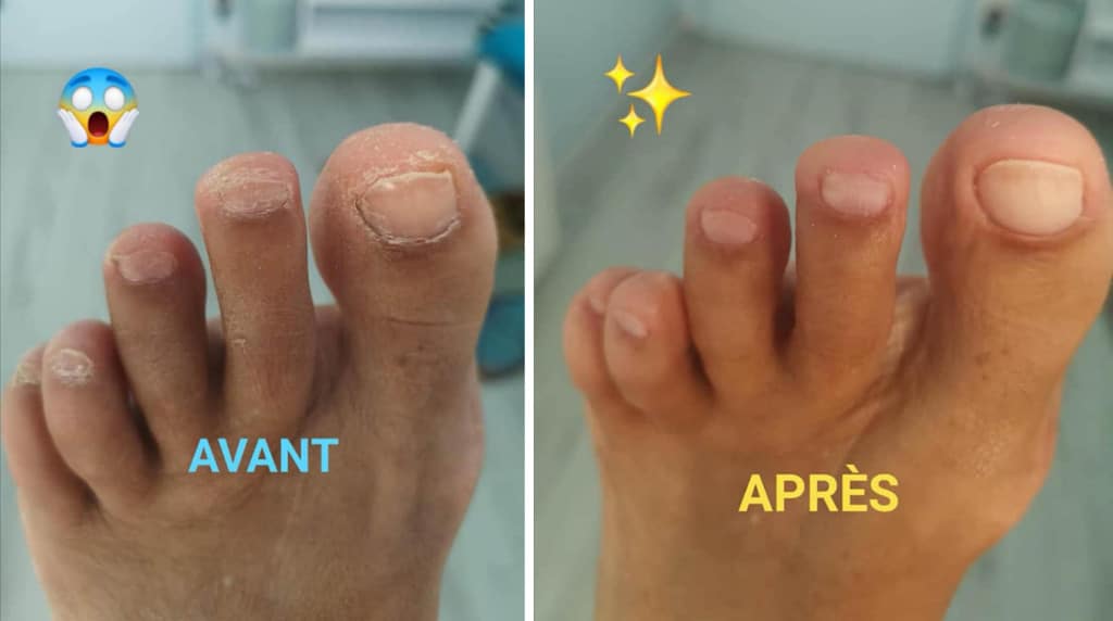 Beauté des pieds avant / après Institut Krysalide